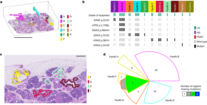 3D genomic mapping reveals multifocality of human pancreatic 
