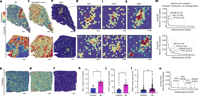 Fig. 2: MI induces focal colonies of IFNICs in humans.