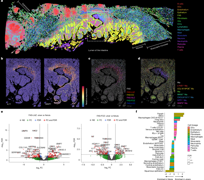 Fig. 3: Fistula-associated fibroblasts line ulcer bases.