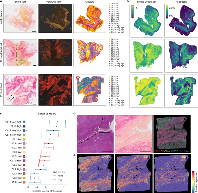 Fig. 5: Disparate functions of fistula-associated fibroblasts in tract evolution and stabilization.