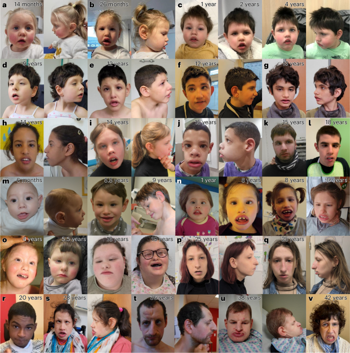 Fig. 4: Facial photographs from 22 patients with the recurrent RNU4-2 c.64_65insT variant.