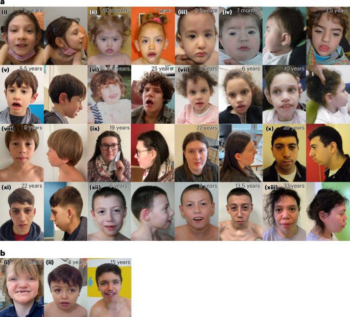 Fig. 5: Facial photographs from 13 patients with other variants in RNU4-2 and two patients with variants in RNU5B-1.
