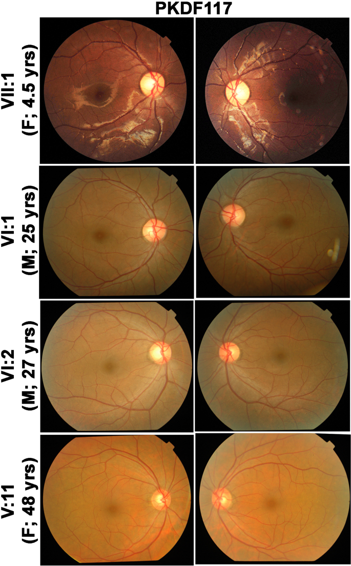 Fig. 1: Fundus images of hearing-impaired individuals of family PKDF117.