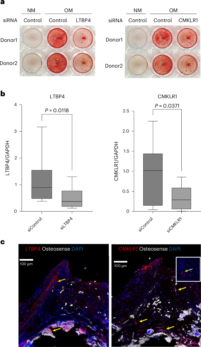 Fig. 6: Suppression of calcification in human VICs cultured in OM by silencing of LTBP4 and CMKLR1, and their colocalization with calcification in human AV.