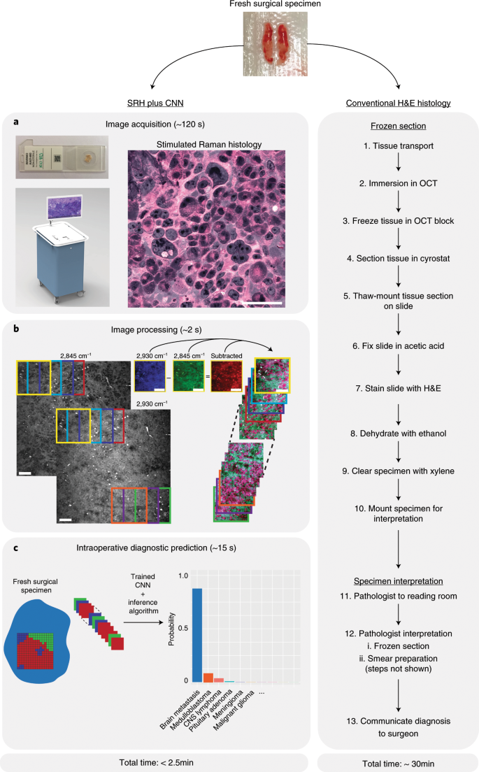 Near real-time intraoperative brain tumor diagnosis using stimulated Raman  histology and deep neural networks | Nature Medicine