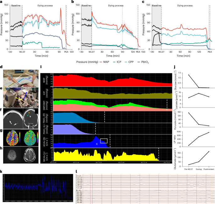 Fig. 2: Timing of intraparenchymal neuromonitoring physiology throughout the dying process until circulatory arrest with pathology correla.