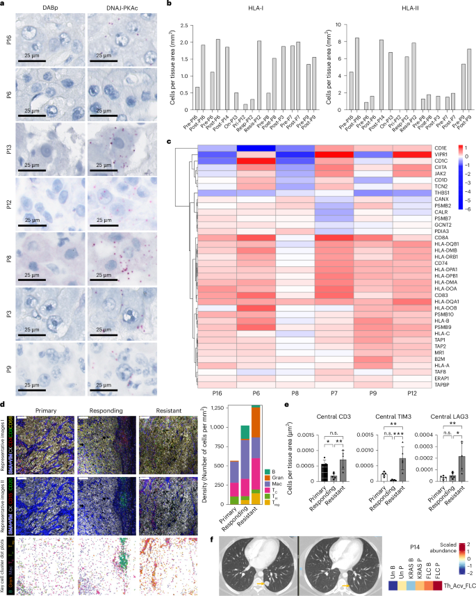 Fig. 4: Acquired resistance correlated with immune exhaustion, with no loss of expression of DNAJ-PKAc.