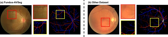 A comparison showing the higher resolution and detail in the new Fundus-AVSeg dataset versus older datasets.