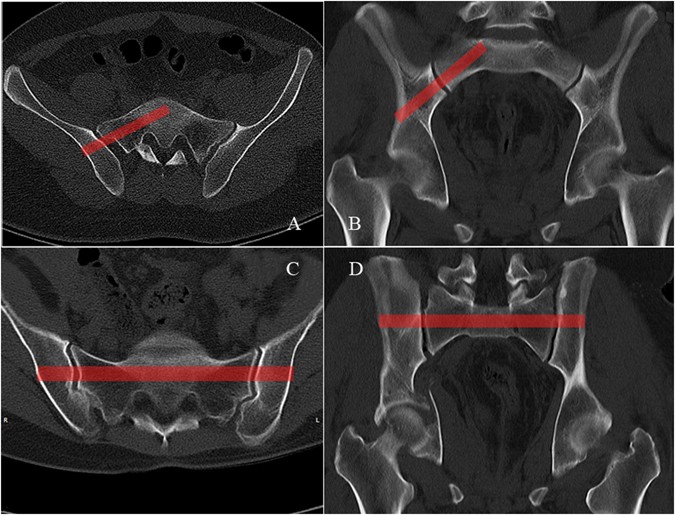 Skinne Afbrydelse Remission Percutaneous Placement of Iliosacral Screws Under the Guidance of Axial  View Projection of the S1 Pedicle: a Case Series | Scientific Reports