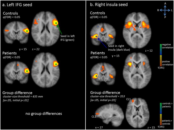Exploration Of The Brain In Rest Resting State Functional Mri Abnormalities In Patients With Classic Galactosemia Scientific Reports Exploration Of The Brain In Rest Resting State Functional Mri Abnormalities In Patients With Classic Galactosemia Scientific Reports