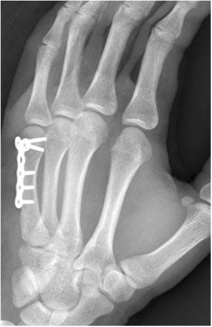 Three-screw versus two-screw fixation of distal fragment in fifth metacarpal  neck fractures stabilized with locking plate | Scientific Reports