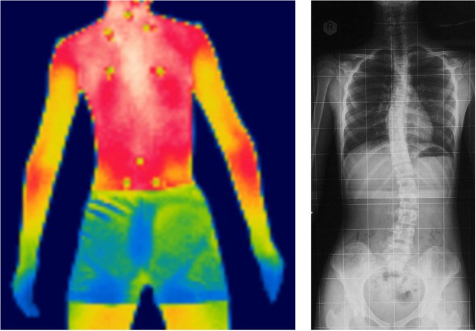 درجة حرارة ظهر مرضى اعوجاج العمود الفقري