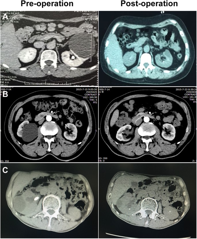 Simple Kidney Cysts Niddk