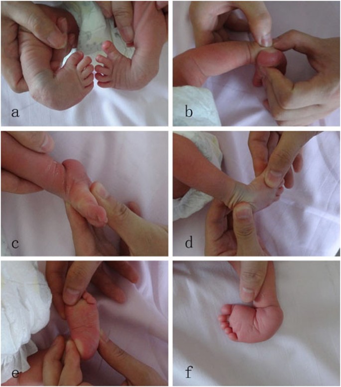 The Correlation Of Pirani And Dimeglio Scoring Systems For Ponseti Management At Different Levels Of Deformity Severity Scientific Reports The Correlation Of Pirani And Dimeglio Scoring Systems For Ponseti Management At Different Levels Of Deformity Severity Scientific Reports