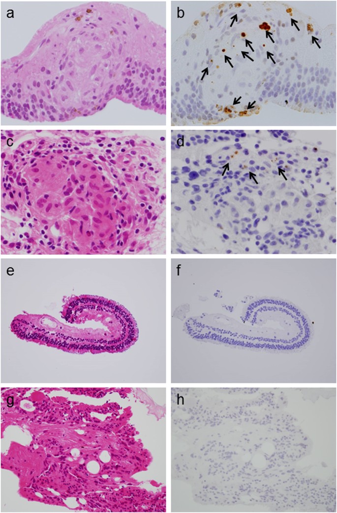 Immunohistochemical Detection Of Propionibacterium Acnes In The Retinal Granulomas In Patients With Ocular Sarcoidosis Scientific Reports