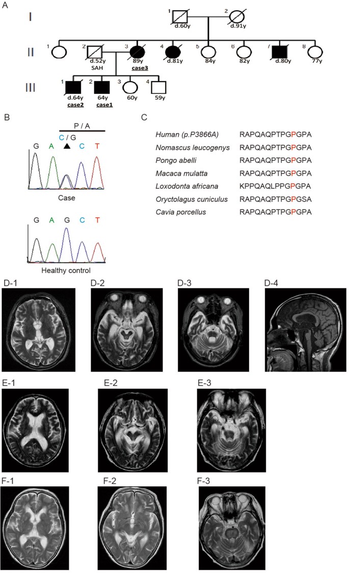 Mutations in bassoon in individuals with familial and sporadic progressive  supranuclear palsy-like syndrome | Scientific Reports