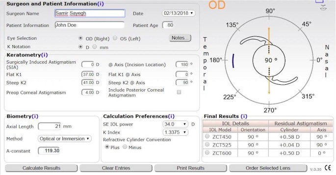 A Direct Method for Determining Toricity Ratios of Toric Intraocular Lens  Calculators | Scientific Reports
