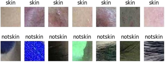 acne skin disease research paper figure 2