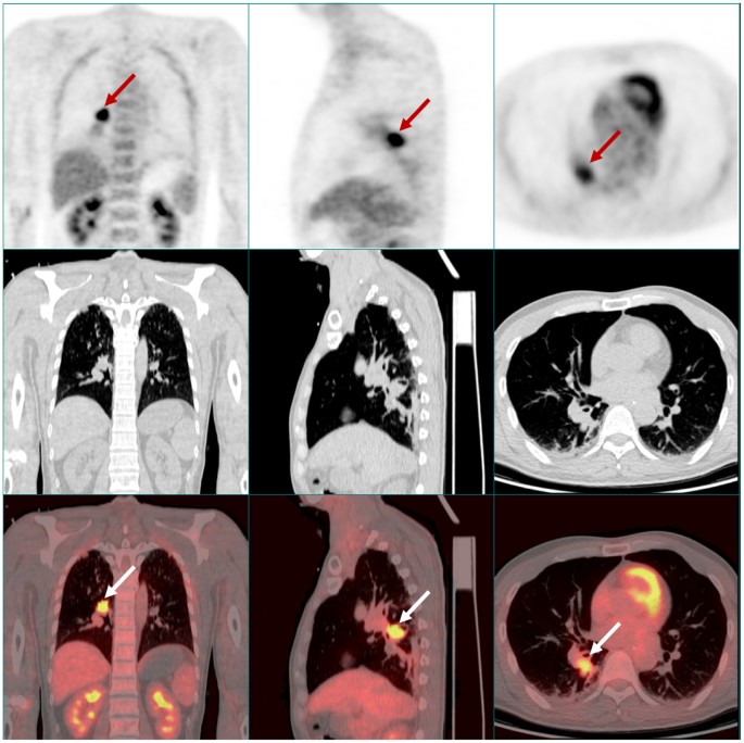 Paraneoplastic Limbic Encephalitis Associated With Lung Cancer Scientific Reports