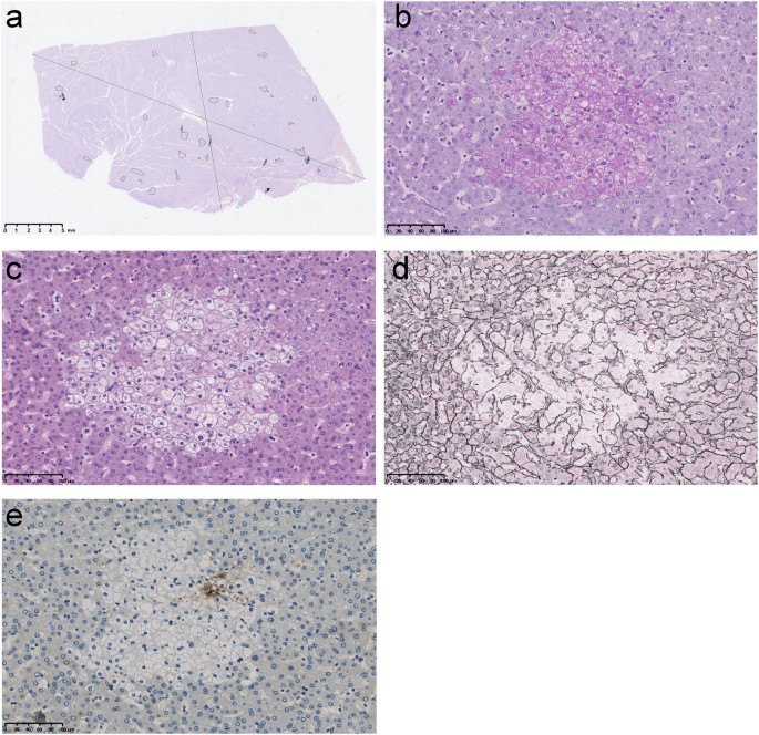 Liver clear cell foci and viral infection are associated with  non-cirrhotic, non-fibrolamellar hepatocellular carcinoma in young patients  from South America | Scientific Reports