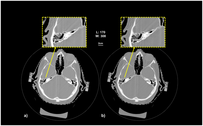 Significant Dose Reduction Using Synchrotron Radiation Computed Tomography First Clinical Case And Application To High Resolution Ct Exams Scientific Reports