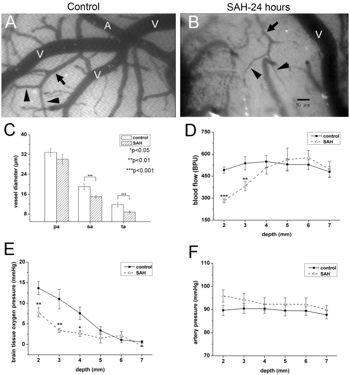 Subarachnoid Hemorrhage (SAH) - Trial Exhibits Inc.