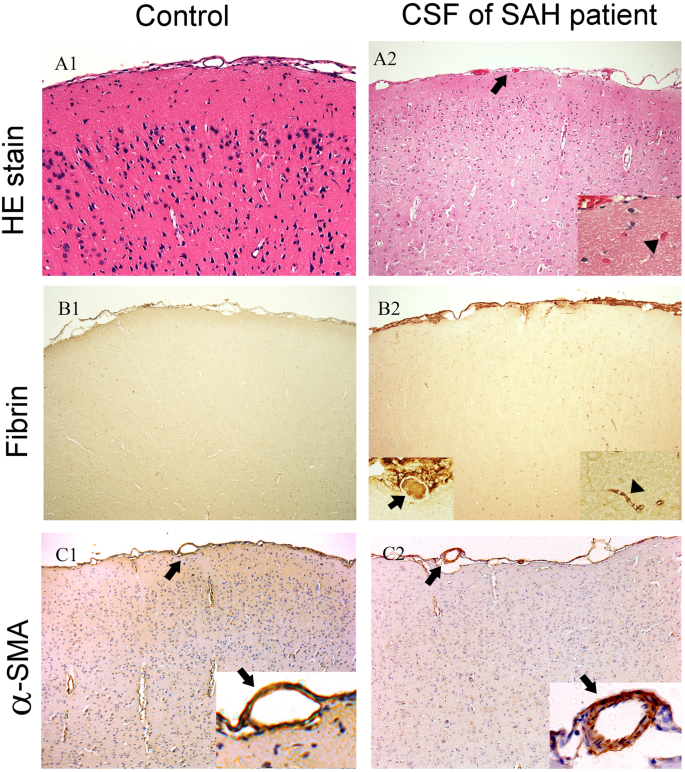 Subarachnoid Hemorrhage (SAH) - Trial Exhibits Inc.