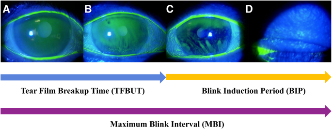Maximum blink interval is associated with tear film breakup time: A simple, screening test for dry eye disease | Scientific Reports