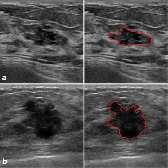 Radiomics of US texture features in differential diagnosis between  triple-negative breast cancer and fibroadenoma | Scientific Reports