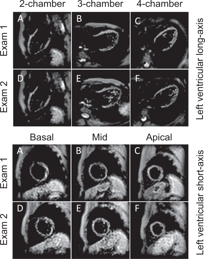 Myocardial Strain Evaluation with Cardiovascular MRI: Physics, Principles,  and Clinical Applications