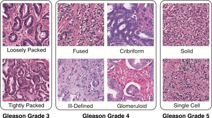 gleason score adenocarcinoma prostate adenoma és prosztatagyulladás különbség