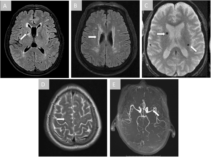 normal brain mri