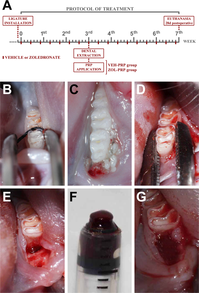 Application of Autologous Platelet-Rich Plasma on Tooth Extraction 