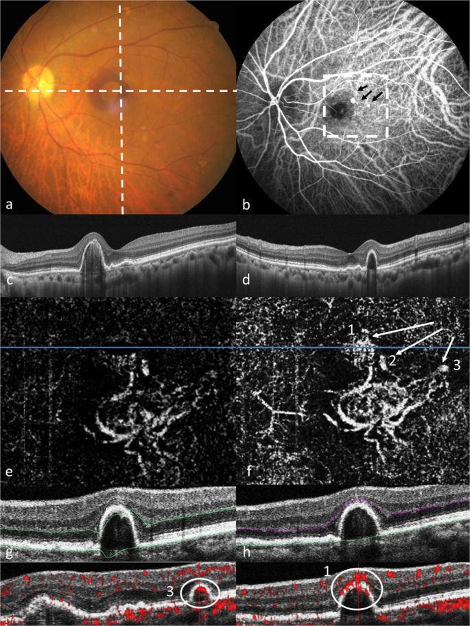 Characterizing Branching Vascular Network Morphology In Polypoidal Choroidal Vasculopathy By Optical Coherence Tomography Angiography Scientific Reports