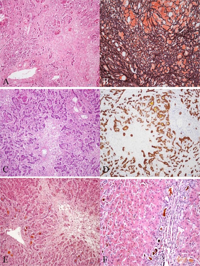 The Clinical Parameters For The Diagnosis Of Hepatitis B Virus Related Acute On Chronic Liver Failure With Sepsis Scientific Reports