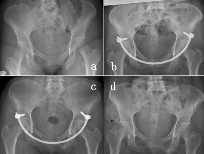 Anterior subcutaneous internal fixator (INFIX) versus plate fixation for  pelvic anterior ring fracture | Scientific Reports