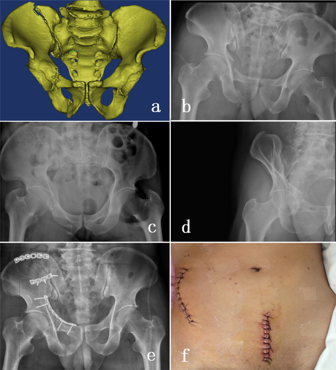 Anterior subcutaneous internal fixator (INFIX) versus plate fixation for  pelvic anterior ring fracture | Scientific Reports