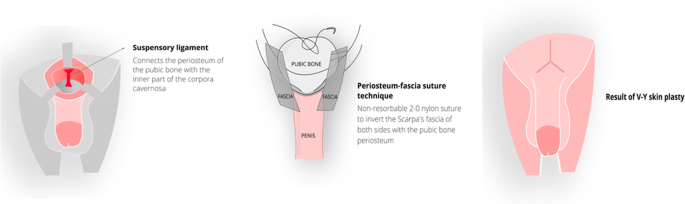 lipofilling penis