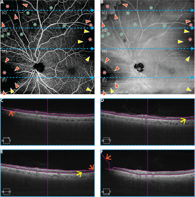 Controlling For Artifacts In Widefield Optical Coherence Tomography Angiography Measurements Of Non Perfusion Area Scientific Reports