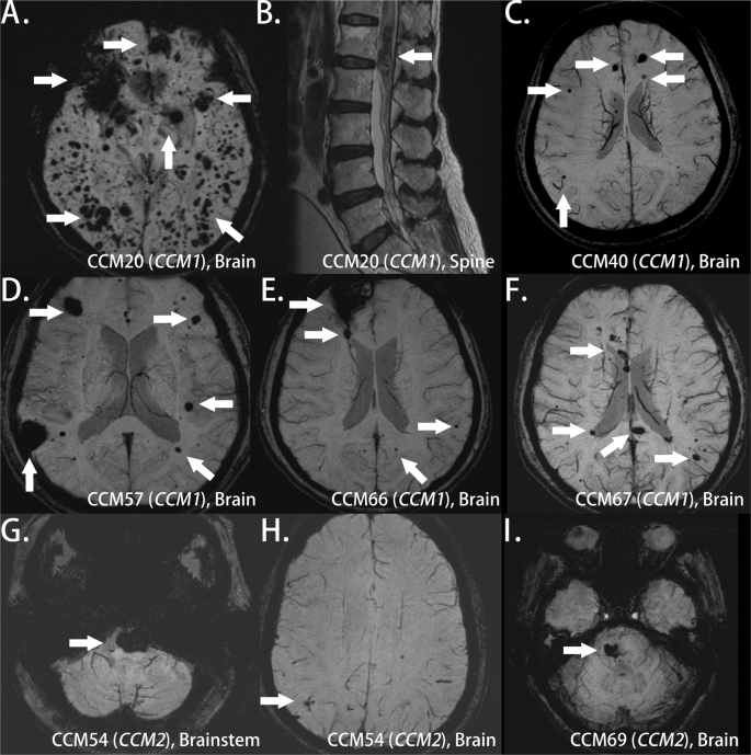 CCM1 and CCM2 variants in patients with cerebral cavernous malformation in  an ethnically Chinese population in Taiwan | Scientific Reports