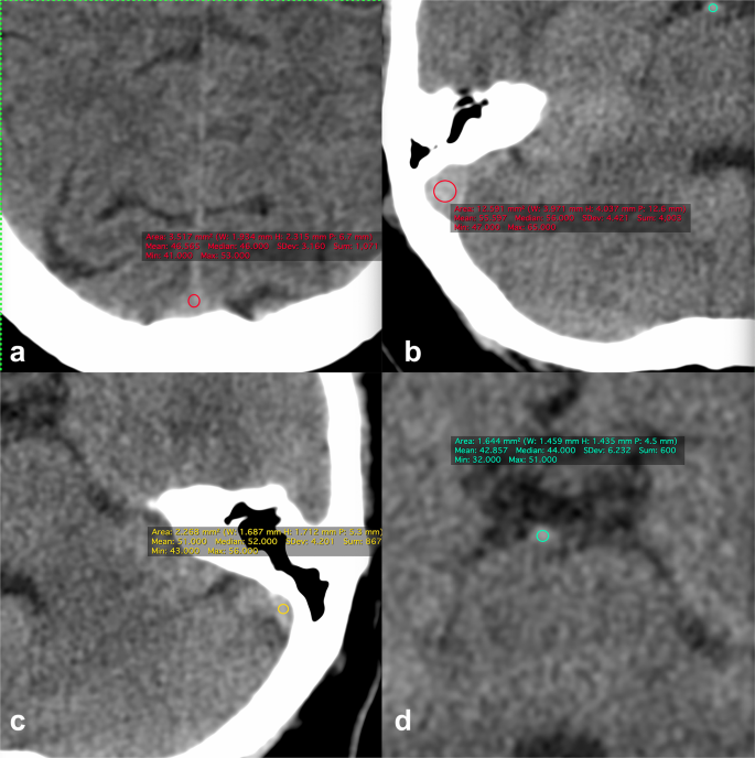 Factors Affecting Dural Sinus Density In Non Contrast Computed Tomography Of Brain Scientific Reports