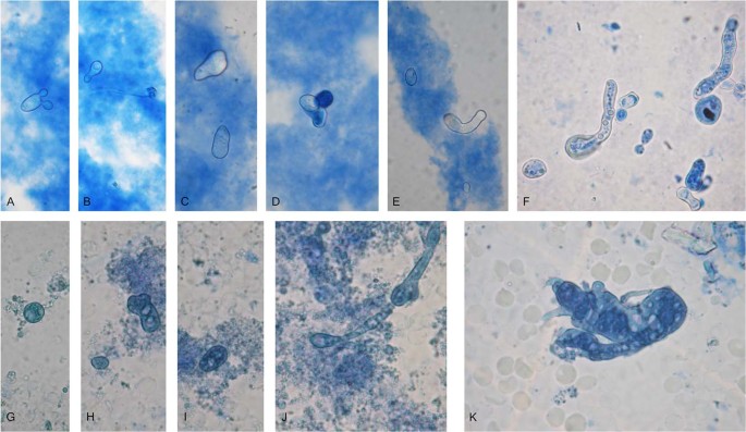 neurodermatitis képek vezetője