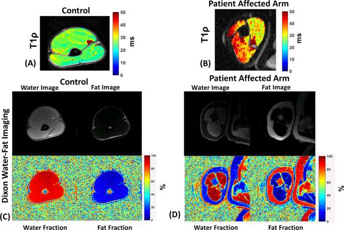 Quantifying Muscle Glycosaminoglycan Levels In Patients With Post Stroke Muscle Stiffness Using T 1r Mri Scientific Reports