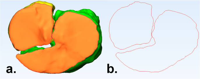 Quantitative 3D measurements of tibial plateau fractures | Scientific  Reports