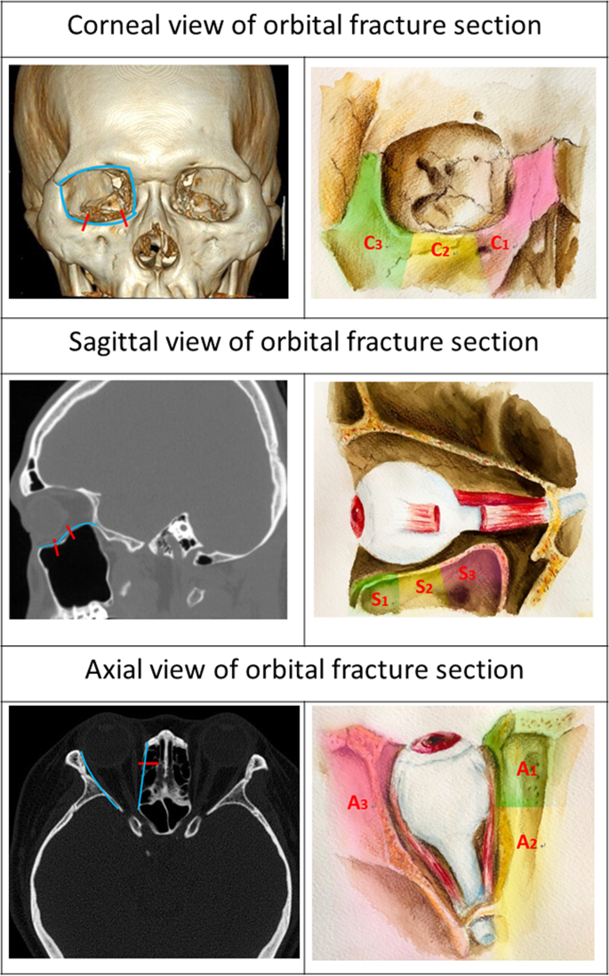 Anatomic Factors Predicting Postoperative Strabismus in Orbital Wall  Fracture Repair | Scientific Reports