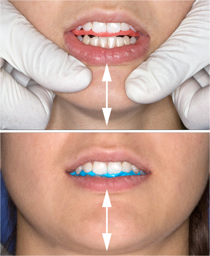 Essential requirements of a non-occlusal mandibu- lar reference position