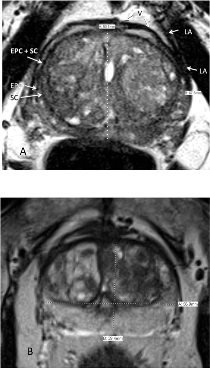 prostate normal volume radiology