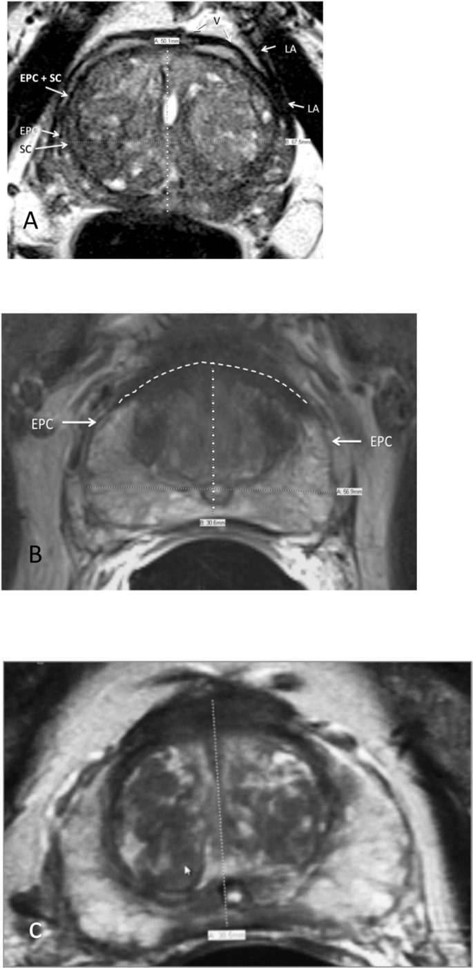 normal prostate size radiology