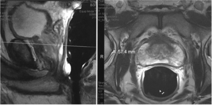 Shemale Prostate