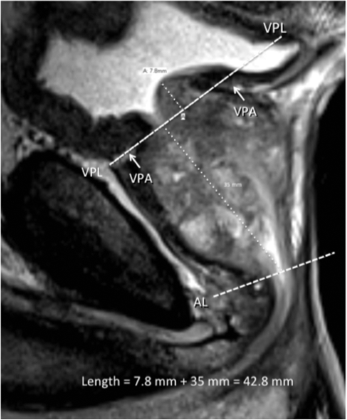 prostate volume calculation formula mri)